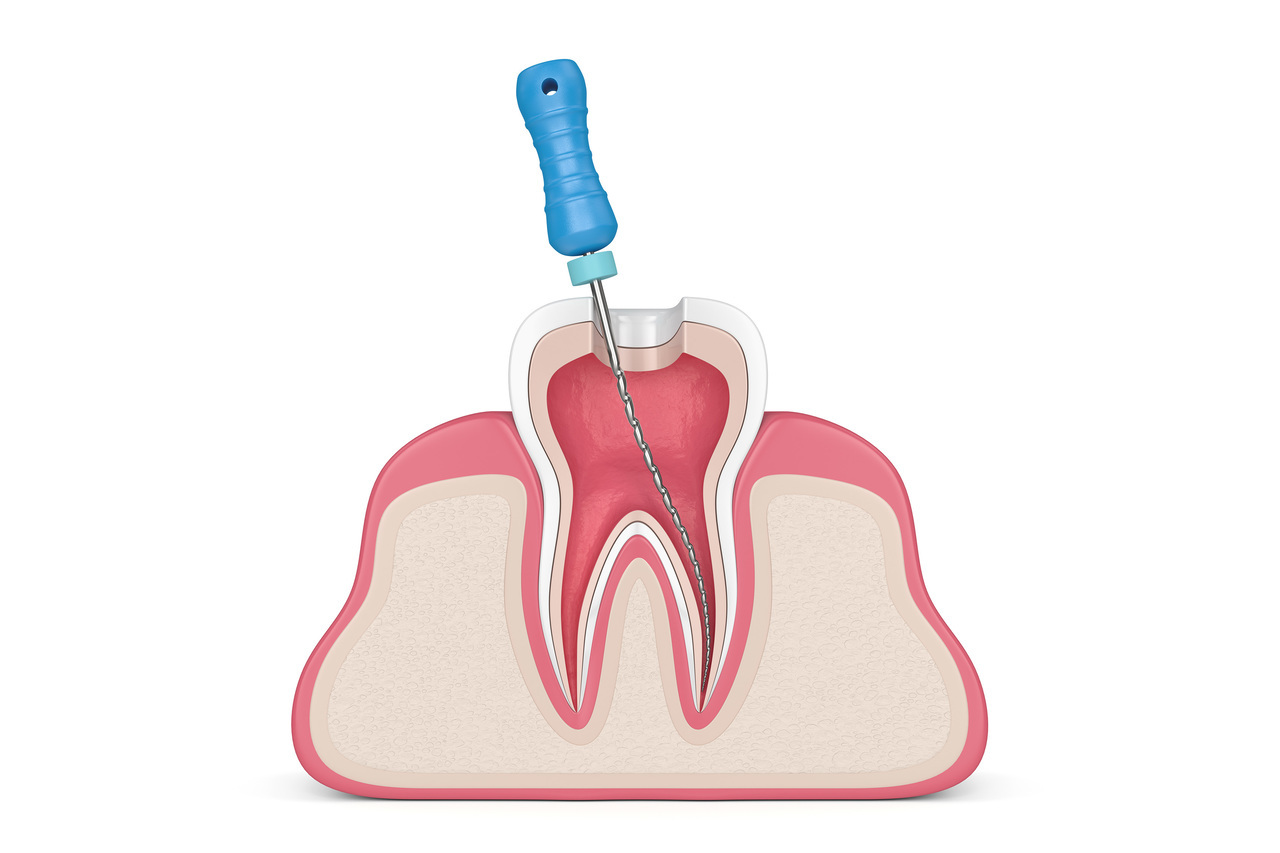 根管治療